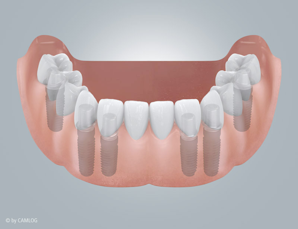 Zahnloser Unterkiefer mit Brückenversorgung
